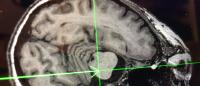 Black and white magnetic resonance (MR) image of the brain